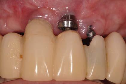 implant and