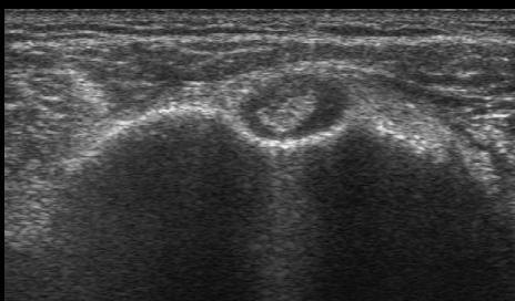 Effusion in the biceps tendon