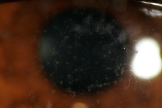 Patient A Slit lamp photo of OD showing GCD Slit lamp photo of
