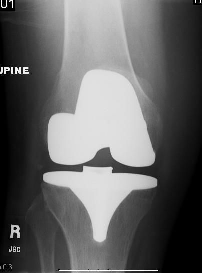 Outcomes for treating widespread cartilage damage (arthritis) with arthroscopic debridement are less