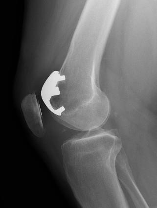 surgery. Recent data shows results and outcomes for unicompartment replacement are approaching that for total knee arthroplasty.