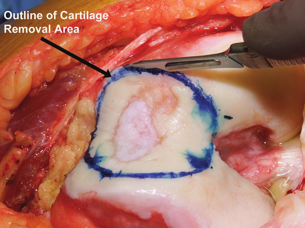 the perimeter for cartilage removal. FIG.