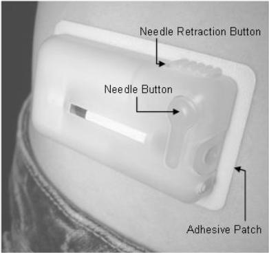 Prandial insulin is delivered by pushing both the bolus release button and the bolus delivery button. Photographs shown are of the commercial product and not the prototype used in this trial.