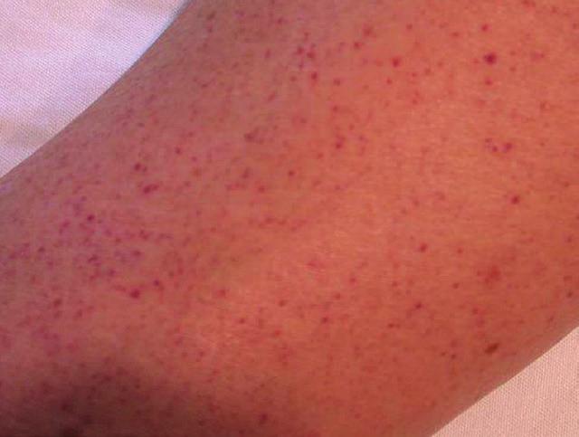 These pictures show examples of spots and bruises caused by ITP. This is an example of a leg with scattered spots under the skin that are red, pink, or purple. They might look like pinpricks.