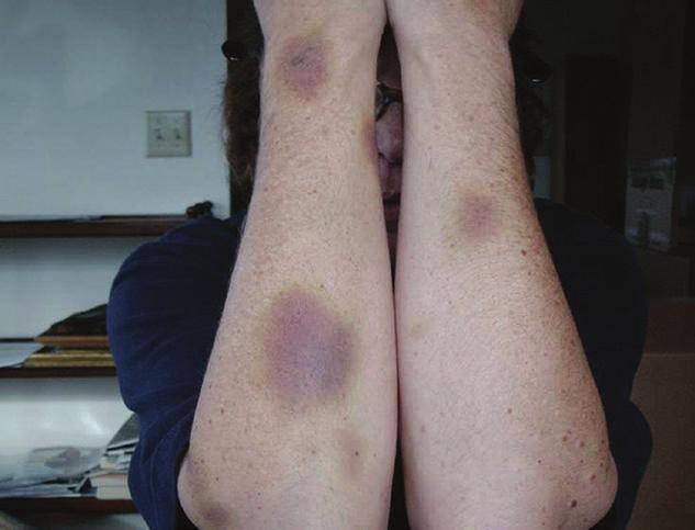 It is important to note bruises could occur anywhere on your body, not just on your arms. This is an example of spots due to bleeding under the tongue.