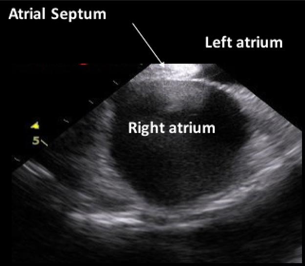 Cardiovascular Diagnosis and Therapy, Vol 8, No 4 August 2018 527 Figure 3 Atrial septum view: this view may be less useful during transcatheter aortic valve