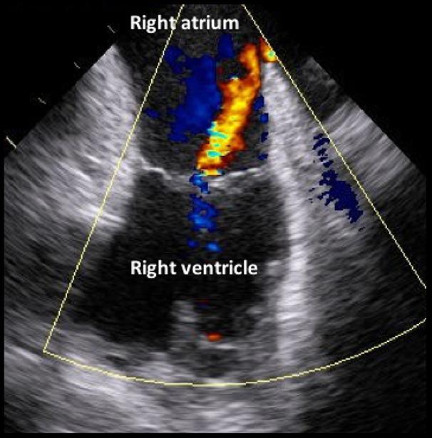 In this view, the preprocedural aortic valve flow velocity was measured (Figure 6B). The diameter of the aortic valve complex was measured (Figure 6C).