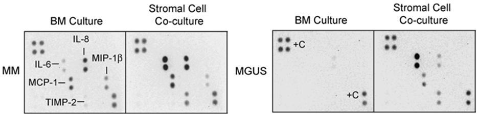 Stromal Cell Involvement in MM Multiple Myeloma, and associated diseases (MGUS) are recruited to the