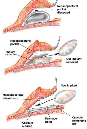 Pocket & Capsule Neosubmuscular pocket If submuscular Anterior capsulectomy versus Complete