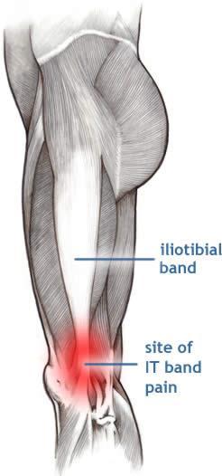 Iliotibial (IT) Band Syndrome The iliotibial band is the tendon attachment of hip muscles into the upper leg (tibia) just below the knee to the outer side of the front of the leg.
