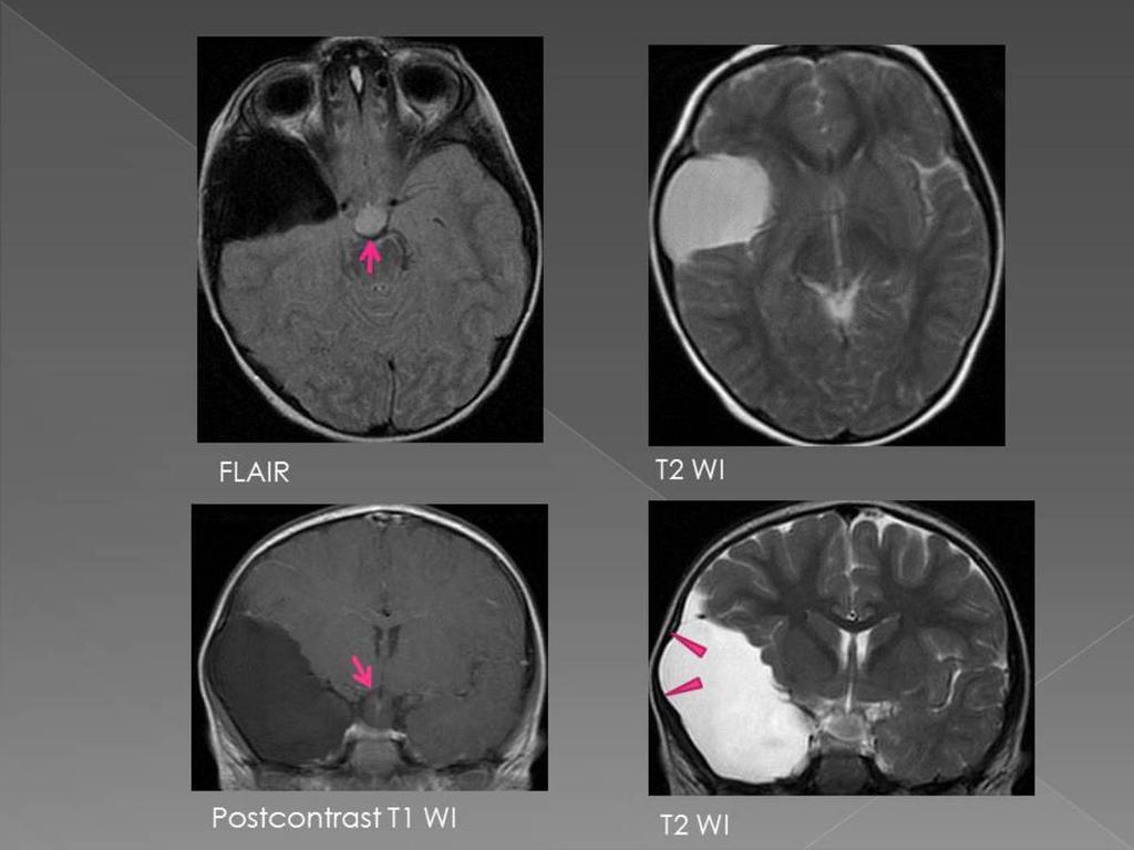 Fig. 6: A 3 year old boy with bulging of the right temporal bone. MRI shows AC in the middle cranial fossa with right temporal lobe atrophy.