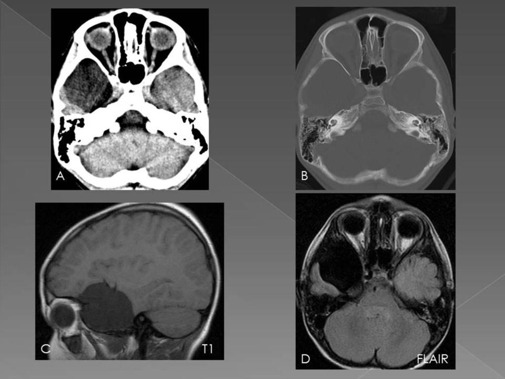 Fig. 8: A 6 year old boy with seizure disorder. A and B)CT scan shows an AC in the right temporal fossa, bone remodeling is observed with enlargement of the temporal fossa.