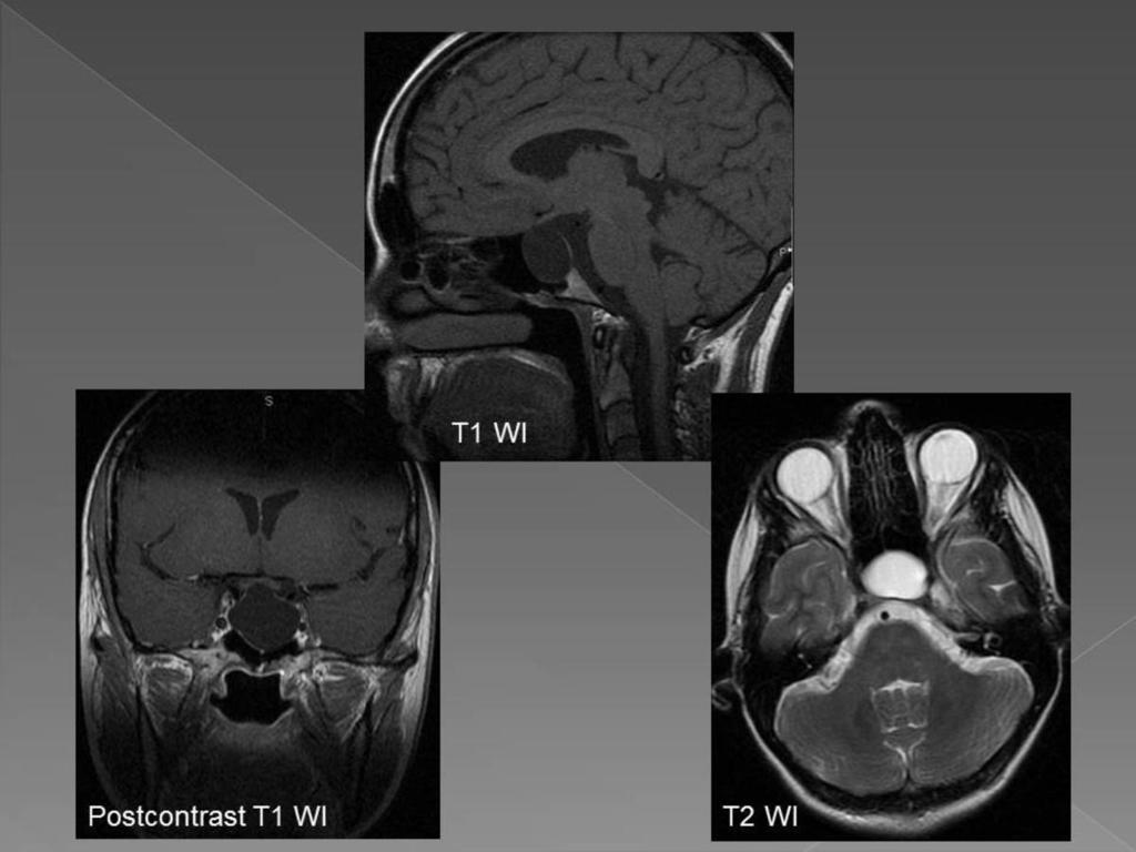 Fig. 9: MR imaging of a 32-year-old female with intrasellar arachnoid