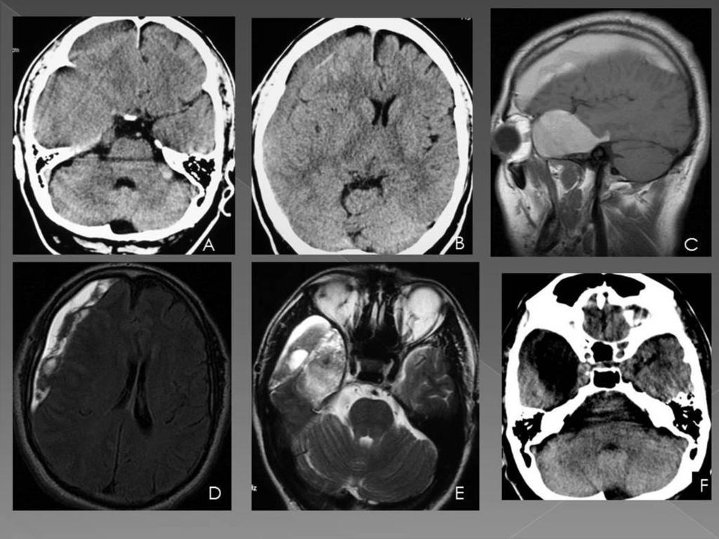 Fig. 10: A 42 year old male with persistent headache of fifteen days. A) and B) CT scan shows subacute subdural hematoma right which is isodense to gray matter, moderate mass effect is observed.