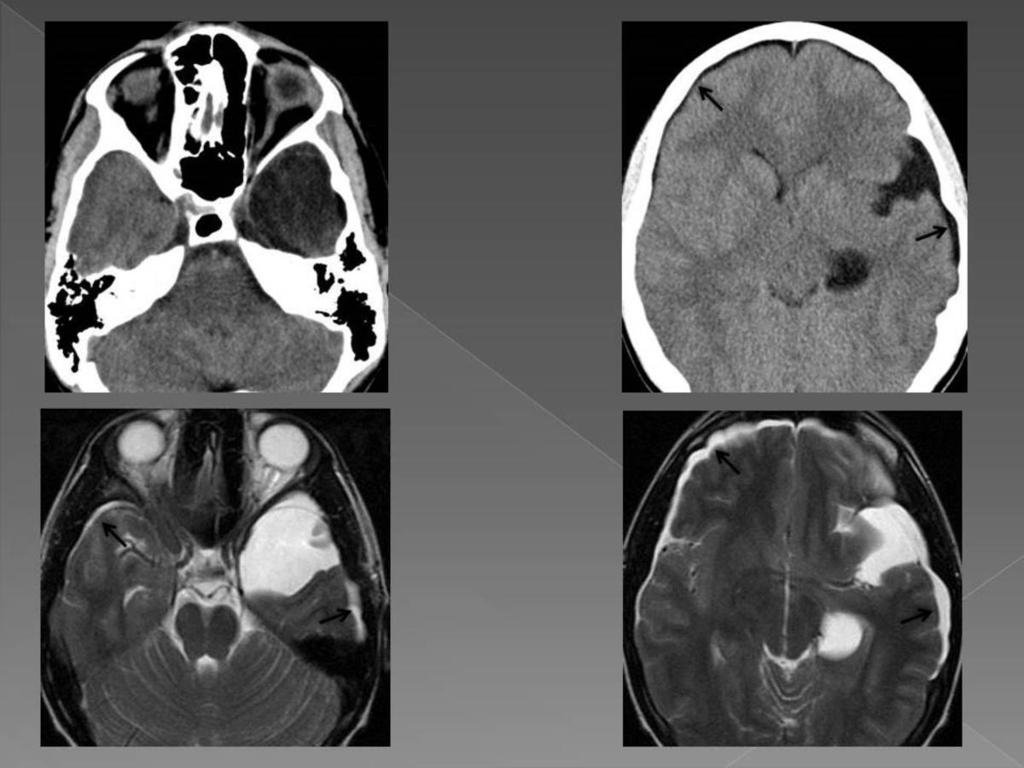 Fig. 11: A 16-year-old boy who presented a 30-day history of gradually worsening headache.