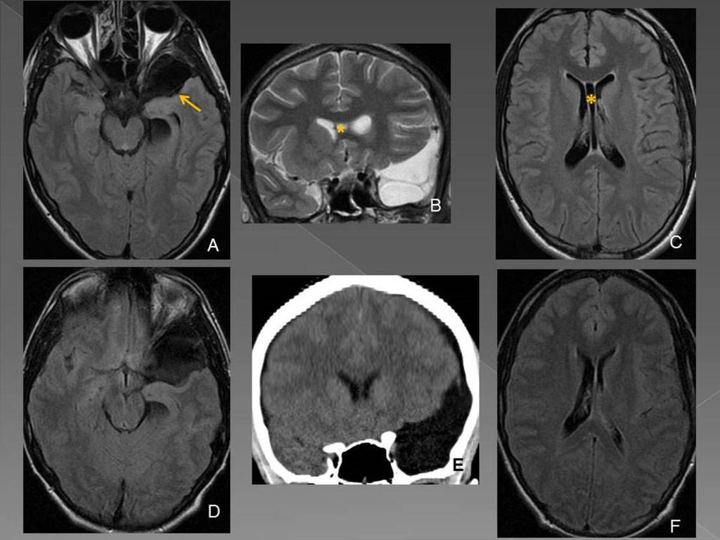 Fig. 12: A, B and C Postoperative MRI at 4 months from patient of figure 11. D, F and E initial imaging. The arachnoid cyst in the right temporal lobe is smaller than the initial imaging (arrow).