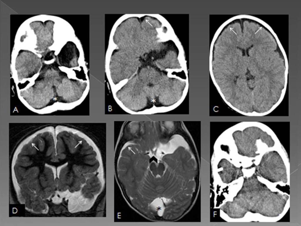 Fig. 13: A 3-year-old boy was seen in our hospital because of headache, vomiting and drowsiness. He had a head injury a month ago.