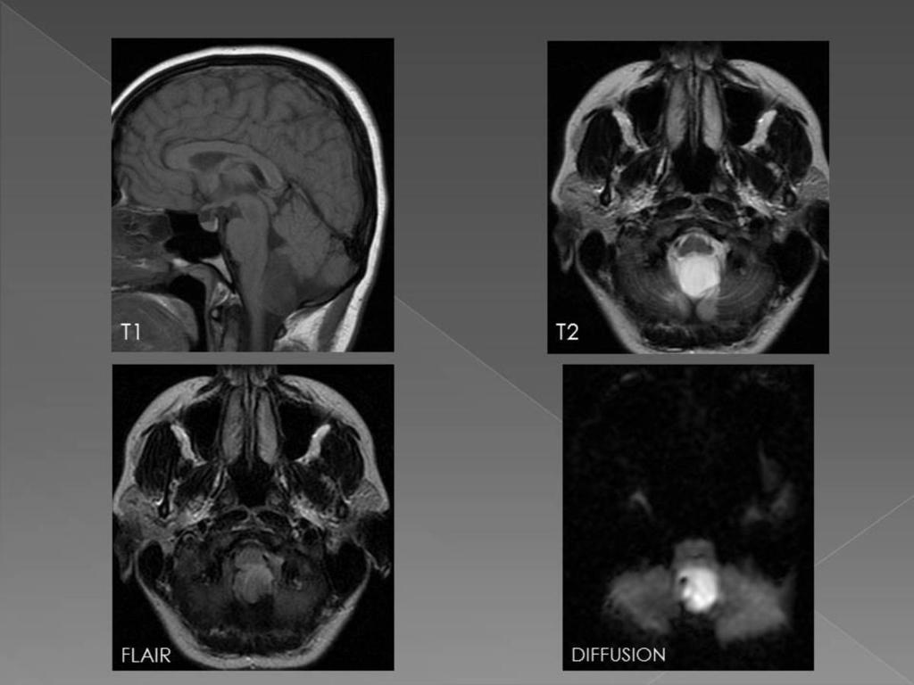 Fig. 14: MR imaging of an epidermoid cyst in the posterior fossa, the cyst is isointense to CSF on both T1 and T2-weighted MR images.
