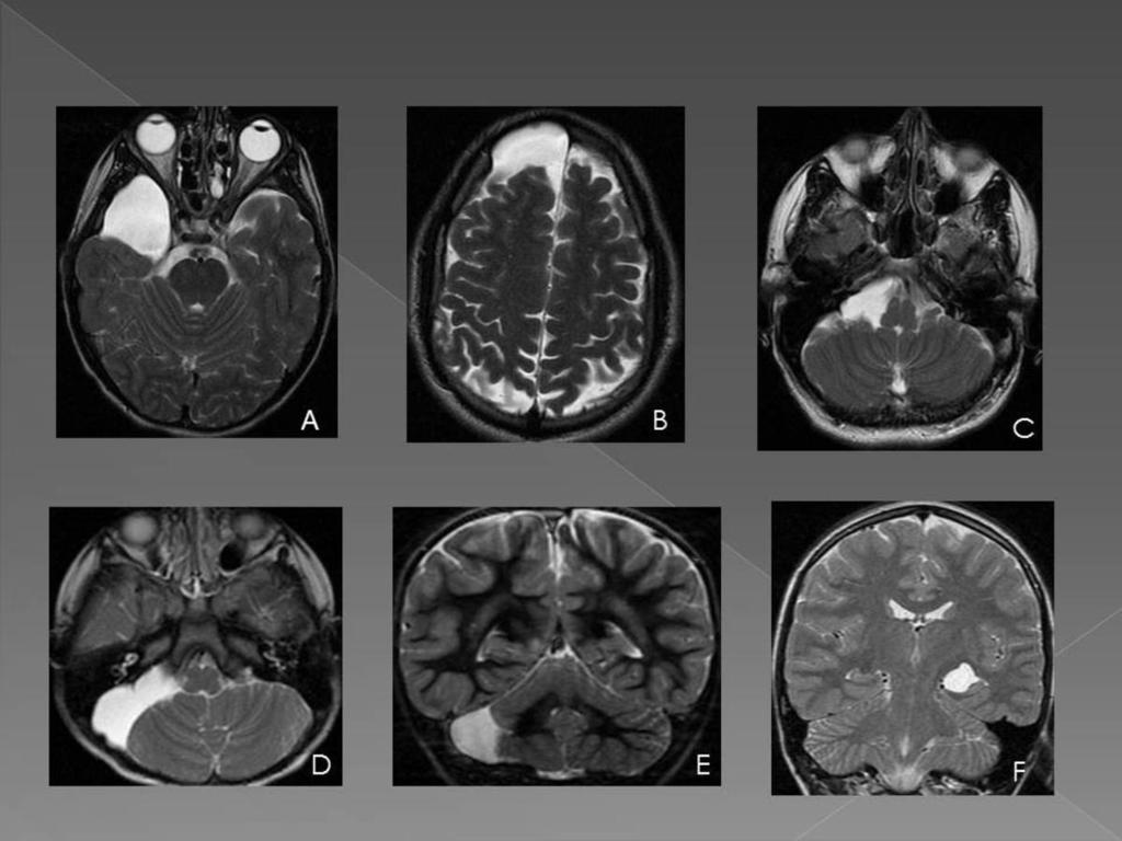 Fig. 1: T2-weighted MR images show different locations of arachnoid cysts. A) Right temporal fossa.