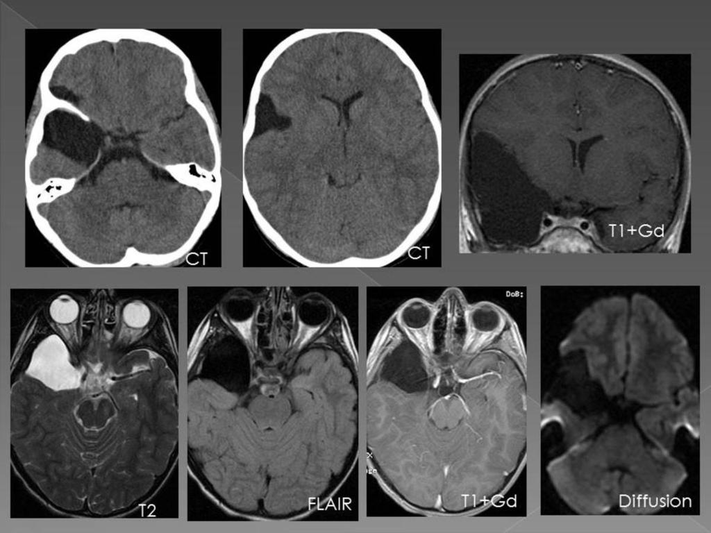 Fig. 3: A 12 year old boy who was admitted in our hospital with diplopia. The CT scan shows AC of the right temporal fossa.