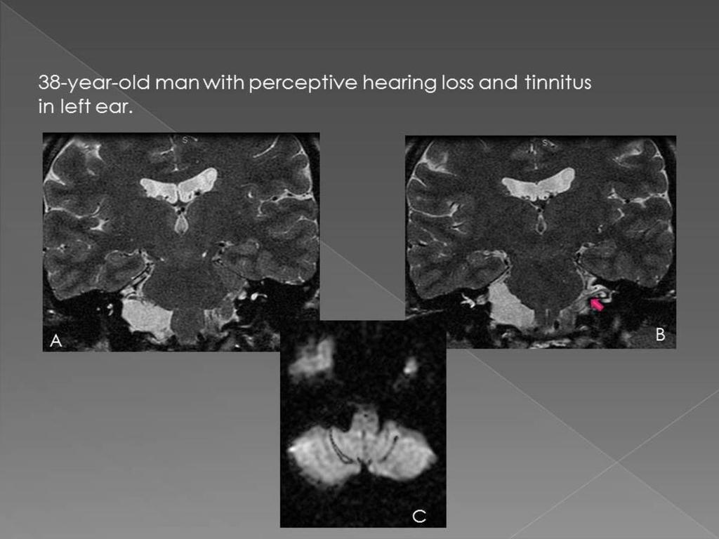 Fig. 4: A and B): Coronal FIESTA (Fast Imaging employing steady-state acquisition) images, show an arachnoid cyst in the right cerebellopontine angle with mass effect and brainstem displacement to
