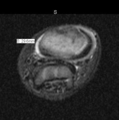 Figure 3 Fig. 3: Transverse MRI evaluation of vascular lesion decision was made to proceed with excisional biopsy/debulking with bloodwork to be drawn the day of surgery.