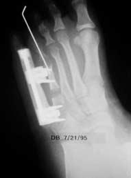 USE OF M 103 IN LENGTHENING OF A CONGENITALLY SHORT 4 TH METATARSAL Insert a 2 mm diameter threaded wire (or 3 mm diameter bone screw) at 45 from the frontal plane and at right angles to the bone