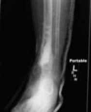 Transforming outcomes in infected non-unions, osteomyelitis, osteomyelitis secondary to diabetes and periprosthetic joint infection 4-6 TRANSFORM OSTEOMYELITIS CAUSED BY GROUP B STREPTOCOCCUS AND