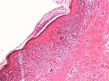 spine, Figure 2b Lichenoid infiltration of lymphohistiocytes and