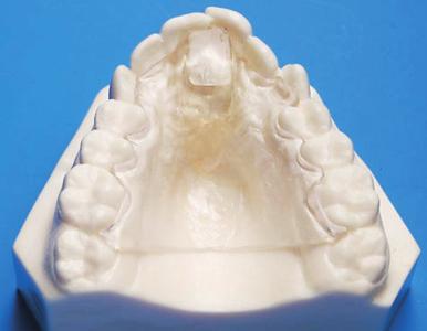 No occlusal coverage, full palatal coverage No guidance No ramp No ramp Point contact for