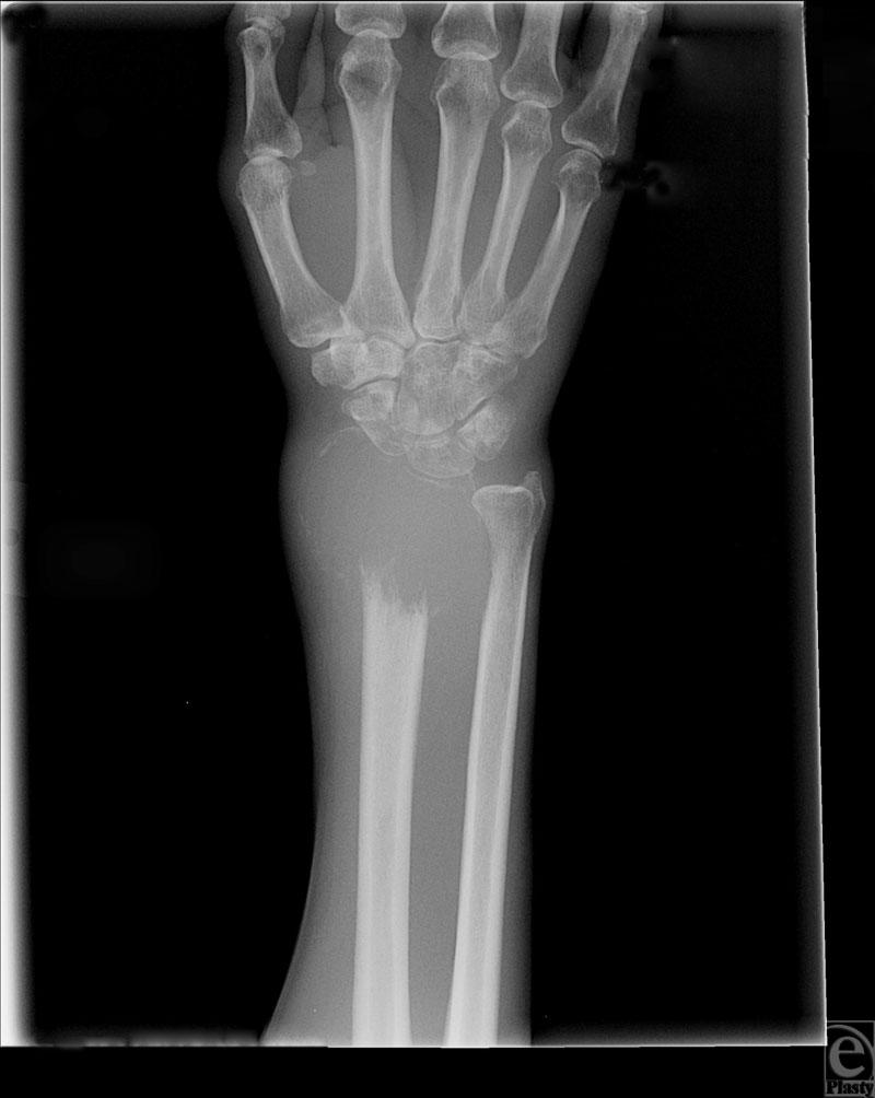 MAYS ET AL Figure 1. Plain radiograph of Giant Cell Tumor of the Wrist demonstrating an osteolytic lesion of the distal radius.