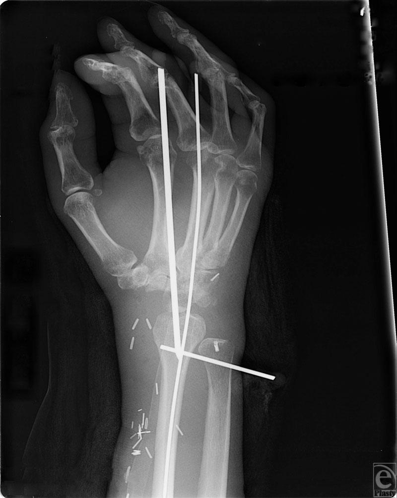 MAYS ET AL Figure 4. Fixation of the fibula in the wrist with K wires. DISCUSSION Giant cell tumors of bone can present with pain, effusion, swelling, and decreased mobility.