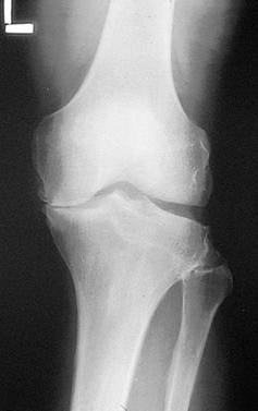 Total knee arthroplasty Treatment for joint disease Osteoarthritis