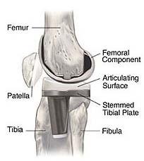 Components Femoral component Tibial component (tibial base plate) Bearing surface Mobile bearing: polyethylene