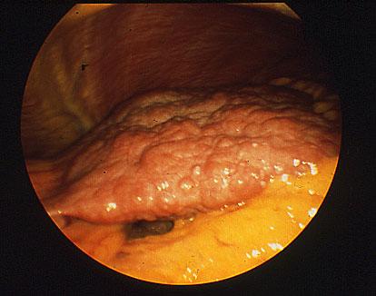 Liver cirrhosis and hepatocellular