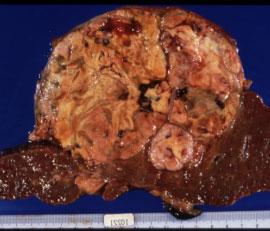 (compensated) Liver cirrhosis