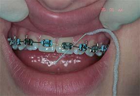 Flossing With Braces: Another way to floss with braces is to use