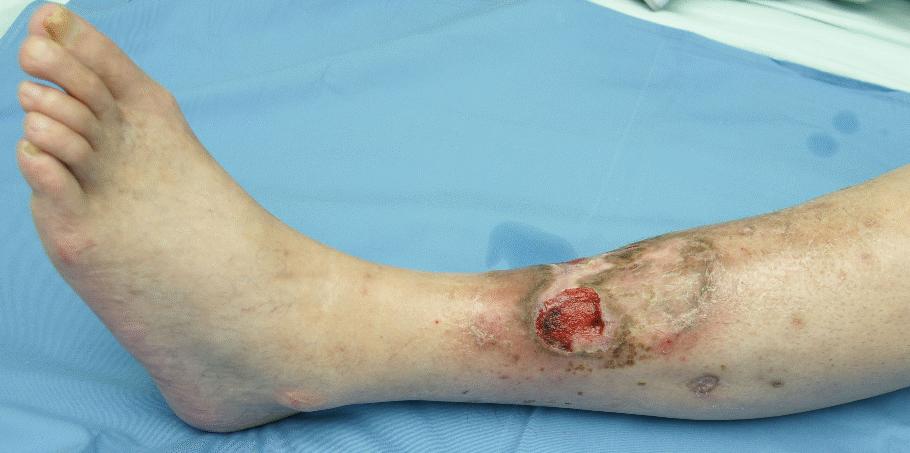 These trophic lesions completely healed after six months. (Figs. 5, 6) Figure 3.