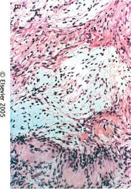 SCHWANNOMA Micro: spindle-cell proliferation with wavy appearance; Biphasic architecture: cellular