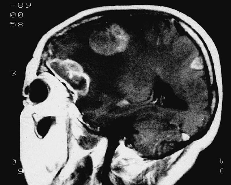 Metastatic Carcinoma Gross/Radiology: Tumor emboli
