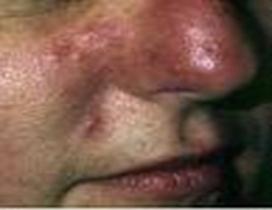 Clinical features of acne vulgaris- black and white heads mainly on face, sometimes affect the chest and upper back.