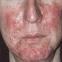 possibility of scarring Conditions to eliminate- rosacea and adverse drug reaction Rosacea- in patients over 40 yrs, acne