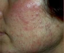 Medicines can cause acne-like eruptions -