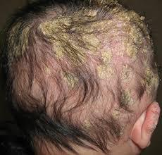 Examine or ask if neck, trunk or back is involved Very common, affects all ages Cradle cap, a type of dandruff that affect babies, causes a scaling,