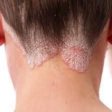 SPECIFIC QUESTIONS TO ASK THE PATIENT Appearance - Differential diagnosis for severe dandruff is psoriasis - In psoriasis the scales are silvery-white and associated with red, patchy plaques and