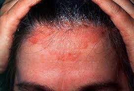 SPECIFIC QUESTIONS TO ASK THE PATIENT Severity- Dandruff is generally a mild condition.