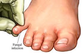 Tinea pedis- athlete s foot- usually seen in the toe webs, especially the fourth web space, space next to the little toe; the skin appears white and