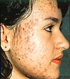 ACNE VULGARIS Acne, is a skin problem that starts when oil and dead skin cells clog up your pores.