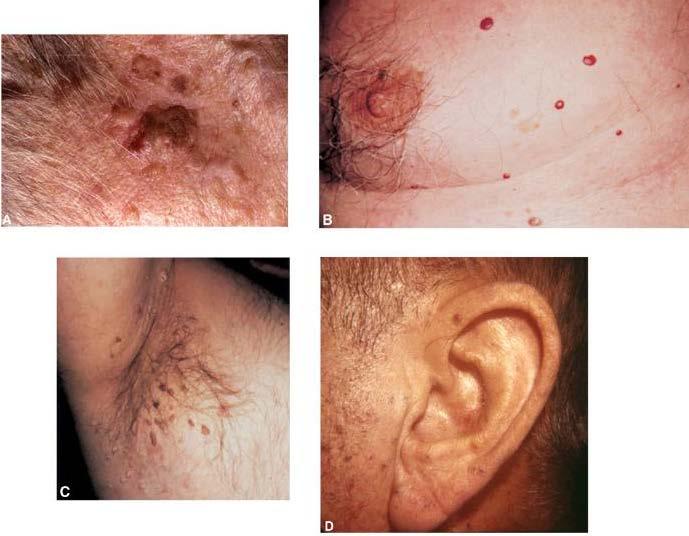 Common skin lesions in older adults. (A) Seborrheic keratosis. (B) Cherry angioma. (C) Skin tag. (D) Venous lakes, or benign venous angiomas. (A and D, Reprinted with permission from Rosenthal, T. C., Williams, M.