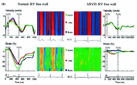 Tissue velocity in Normal vs RV dysplasia